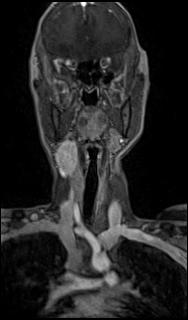 Bilateral carotid body tumors and right glomus jugulare tumor (Radiopaedia 20024-20060 MRA 14).jpg