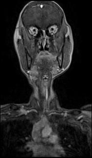 File:Bilateral carotid body tumors and right glomus jugulare tumor (Radiopaedia 20024-20060 MRA 7).jpg