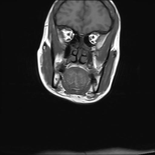 File:Bilateral carotid body tumors and right jugular paraganglioma (Radiopaedia 20024-20060 Coronal 9).jpg