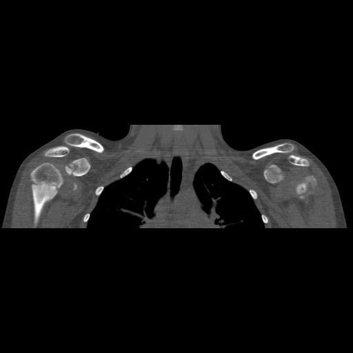 Bilateral chronic posterior shoulder dislocation (Radiopaedia 39213-41452 Coronal bone window 23).jpg
