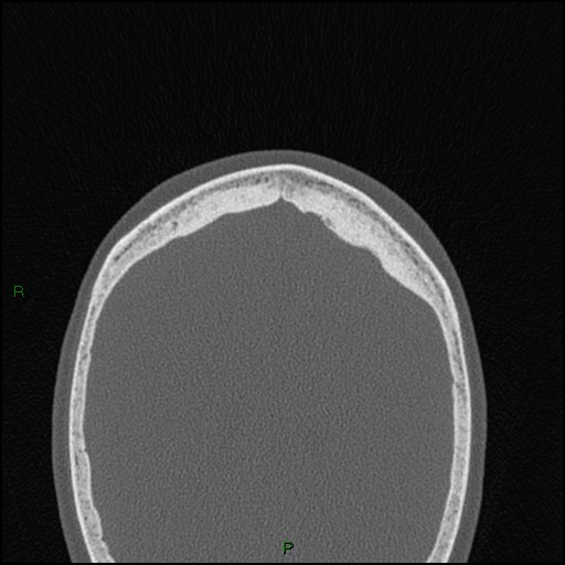 File:Bilateral frontal mucoceles (Radiopaedia 82352-96454 Axial bone window 18).jpg