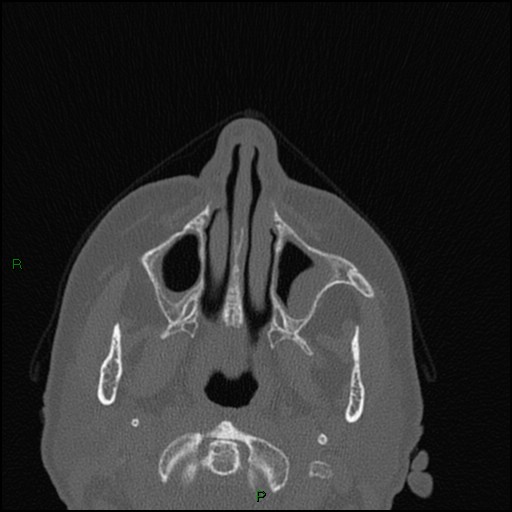 Bilateral frontal mucoceles (Radiopaedia 82352-96454 Axial bone window 218).jpg