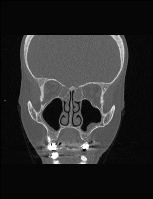 Bilateral frontal mucoceles (Radiopaedia 82352-96454 Coronal 149).jpg