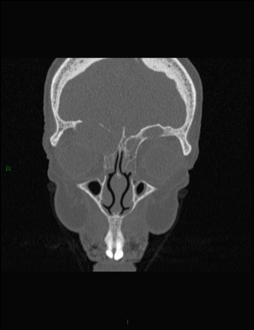 Bilateral frontal mucoceles (Radiopaedia 82352-96454 Coronal 94).jpg