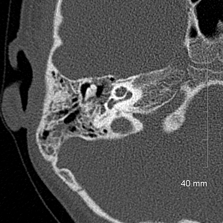 Bilateral grommets (Radiopaedia 47710-52404 Axial bone window 37).jpg