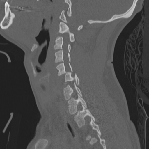 Bilateral locked facets (Radiopaedia 33850-35016 Sagittal bone window 15).png