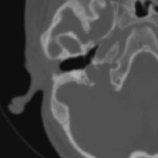 Bilateral otosclerosis (Radiopaedia 57237-64157 B 42).jpg