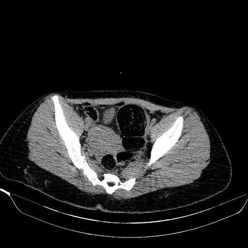 File:Bilateral ovarian dermoid (Radiopaedia 45714-49907 Axial non-contrast 24).JPEG