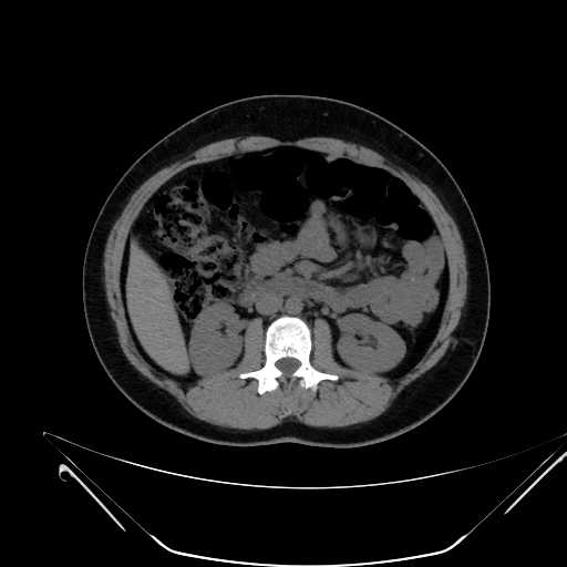File:Bilateral ovarian mature cystic teratomas (Radiopaedia 79373-92457 Axial non-contrast 24).jpg