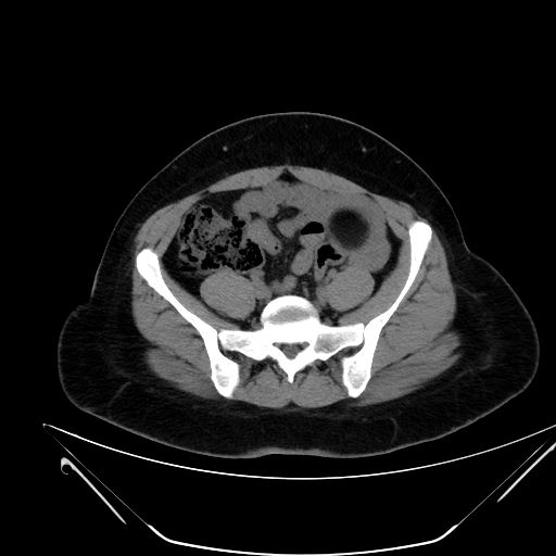 Bilateral ovarian mature cystic teratomas (Radiopaedia 79373-92457 Axial non-contrast 45).jpg
