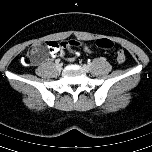 File:Bilateral ovarian teratoma (Radiopaedia 83131-97503 B 16).jpg