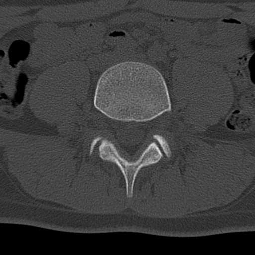 Bilateral pars defect (Radiopaedia 26691-26846 Axial bone window 36).jpg