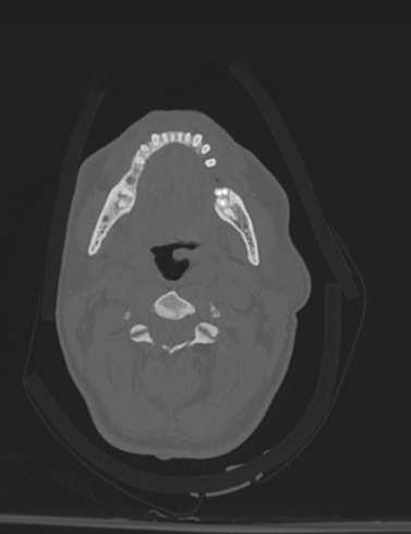 Bilateral perched facet joint (Radiopaedia 63149-71669 Axial bone window 13).jpg