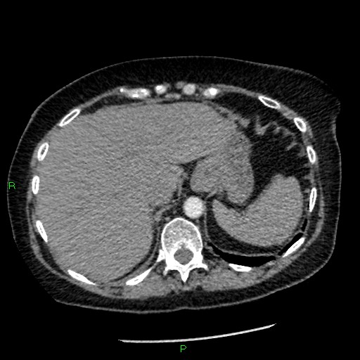 Bilateral pulmonary emboli (Radiopaedia 32700-33669 Axial C+ CTPA 97).jpg