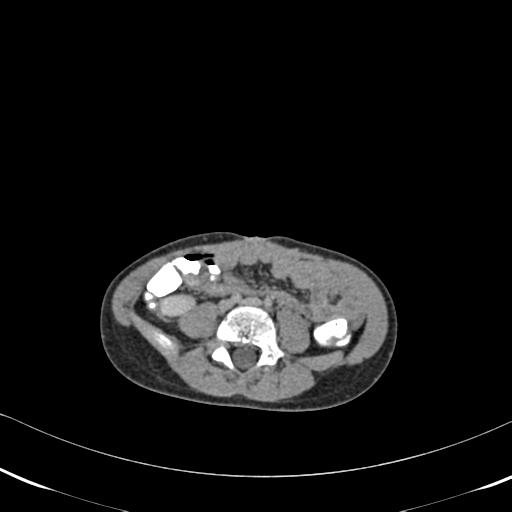 File:Bilateral renal malrotation (Radiopaedia 30901-31606 A 12).jpg