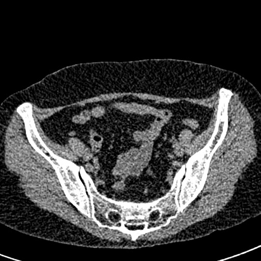 Bilateral staghorn calculi (Radiopaedia 59475-66842 Axial non-contrast 64).jpg