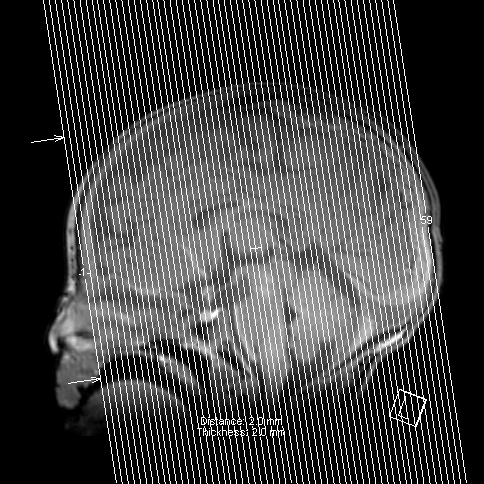 Bilateral subdural hemorrhage and parietal skull fracture (Radiopaedia 26058-26190 Coronal T1 60).png