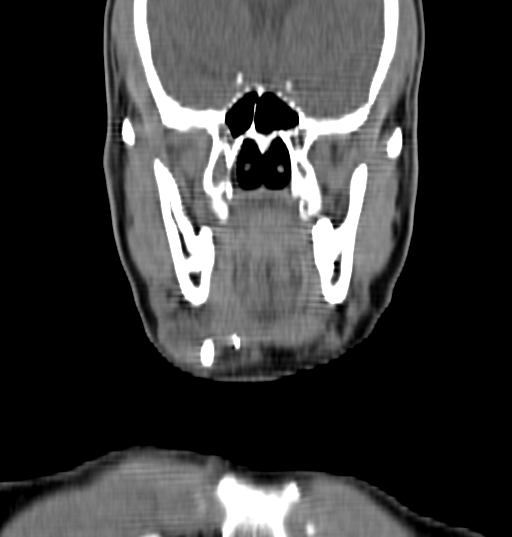 Bilateral submandibular sialolithiasis with sialadenitis (Radiopaedia 70721-80881 Coronal non-contrast 11).jpg