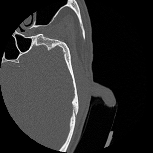 Bilateral temporal bone fractures (Radiopaedia 29482-29970 D 124).jpg