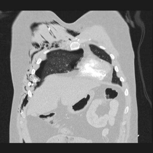 Bilateral traumatic renovascular injury (Radiopaedia 32051-32995 Coronal lung window 18).jpg