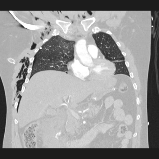 Bilateral traumatic renovascular injury (Radiopaedia 32051-32995 Coronal lung window 32).jpg