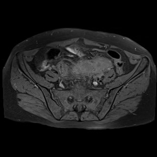 Bilateral tubo-ovarian abscesses (Radiopaedia 58635-65829 Axial T1 fat sat 9).jpg