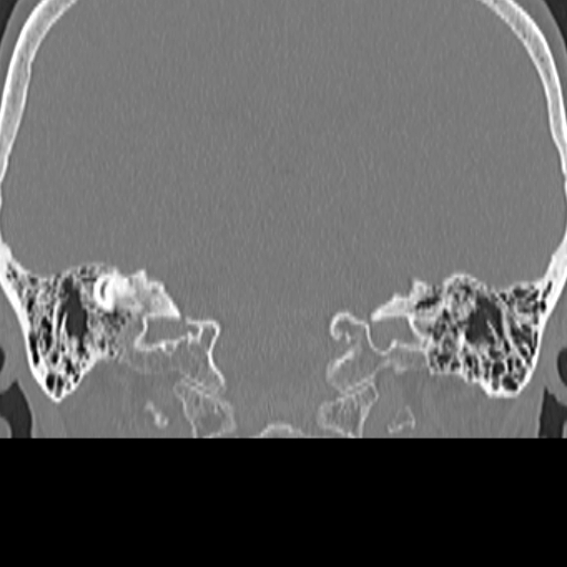 File:Bilateral tympanoplasty (Radiopaedia 16947-16664 Coronal bone window 22).jpg