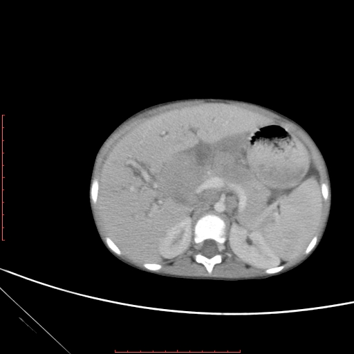 Biliary tract embryonal rhabdomyosarcoma (Radiopaedia 51815-57648 A 34).jpg