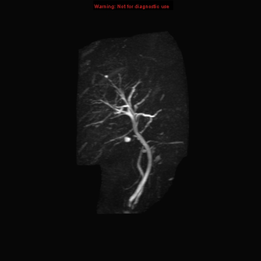 File:Biliary tree anatomical variant - biliary trifurcation (Radiopaedia 12531-12750 Coronal 3D MRCP 19).jpg