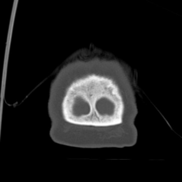 Biparietal osteodystrophy (Radiopaedia 46109-50463 Coronal bone window 104).jpg