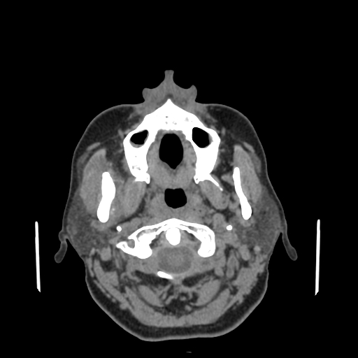 File:Bisphosphonate-related osteonecrosis of the jaw (Radiopaedia 71324-81642 non-contrast 115).jpg