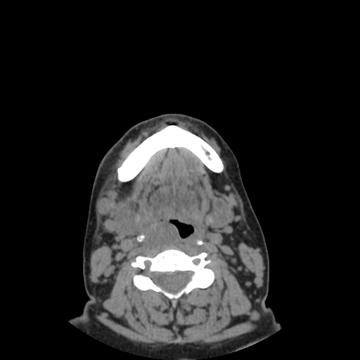 Bisphosphonate-related osteonecrosis of the jaw (Radiopaedia 71324-81642 non-contrast 28).jpg