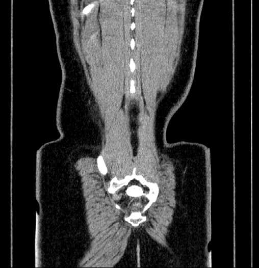 File:Blind-ending branch of a bifid ureter (Radiopaedia 61159-69048 F 66).jpg