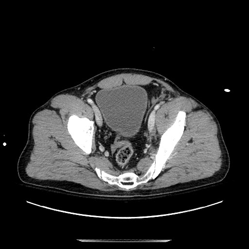 Blunt abdominal trauma with solid organ and musculoskelatal injury with active extravasation (Radiopaedia 68364-77895 A 134).jpg