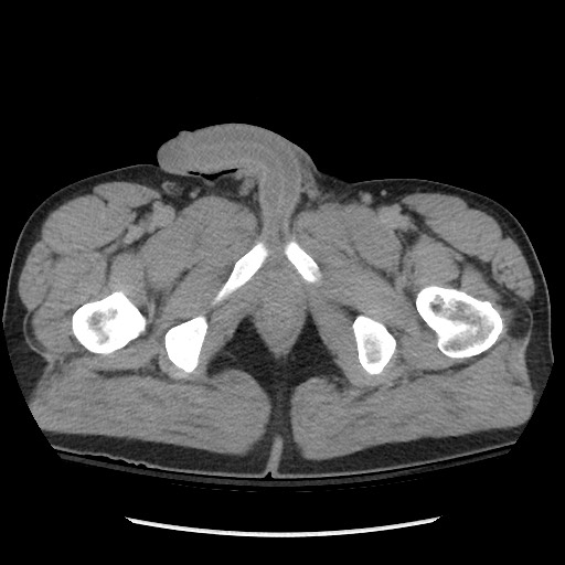 File:Blunt abdominal trauma with solid organ and musculoskelatal injury with active extravasation (Radiopaedia 68364-77895 Axial C+ delayed 145).jpg