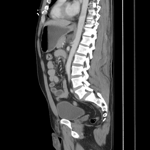 File:Blunt abdominal trauma with solid organ and musculoskelatal injury with active extravasation (Radiopaedia 68364-77895 C 83).jpg