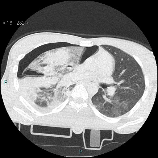 Blunt chest trauma (Swiss cheese sign) (Radiopaedia 38519-40618 Axial lung window 34).jpg