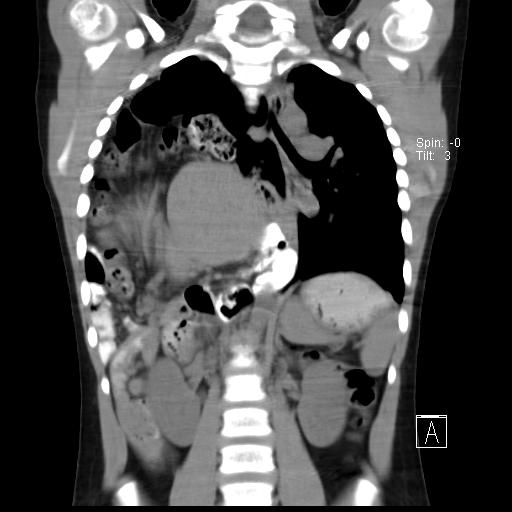 File:Bochdalek diaphragmatic hernia (Radiopaedia 38866-41059 Coronal liver window 13).jpg