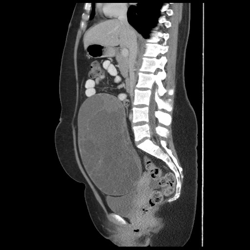 File:Borderline mucinous tumor (ovary) (Radiopaedia 78228-90808 B 34).jpg