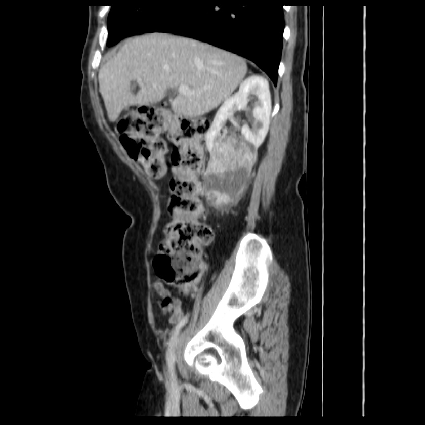 Bosniak renal cyst - type IV (Radiopaedia 22929-22953 G 21).jpg