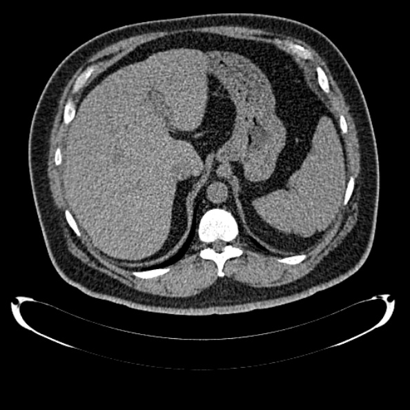 Bosniak renal cyst - type IV (Radiopaedia 24244-24518 Axial non-contrast 88).jpg