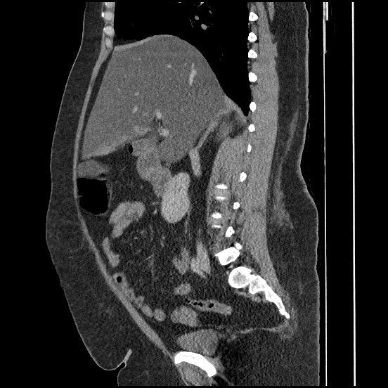 Bowel and splenic infarcts in acute lymphocytic leukemia (Radiopaedia 61055-68913 C 47).jpg