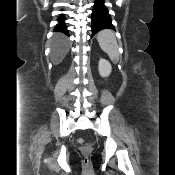 Bowel and splenic infarcts in acute lymphocytic leukemia (Radiopaedia 61055-68915 B 45).jpg