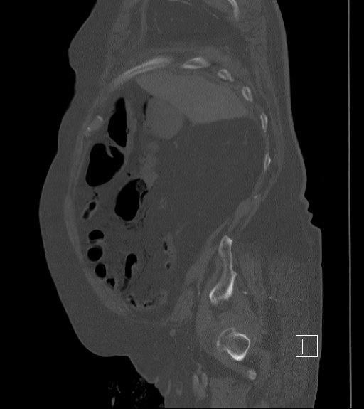 Bowel ischemia secondary to SMA occlusion with extensive portomesenteric venous gas (Radiopaedia 54656-60871 Sagittal bone window 93).jpg