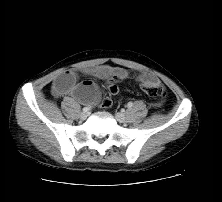 Bowel obstruction from colon carcinoma (Radiopaedia 22995-23028 A 63).jpg