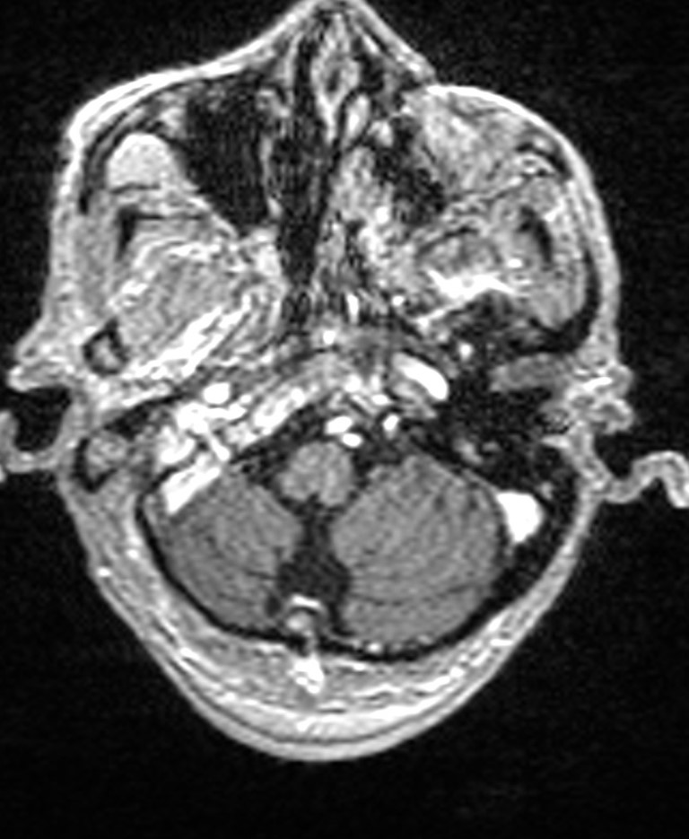 Brain abscess with dual rim sign (Radiopaedia 87566-103938 Axial T1 C+ 32).jpg