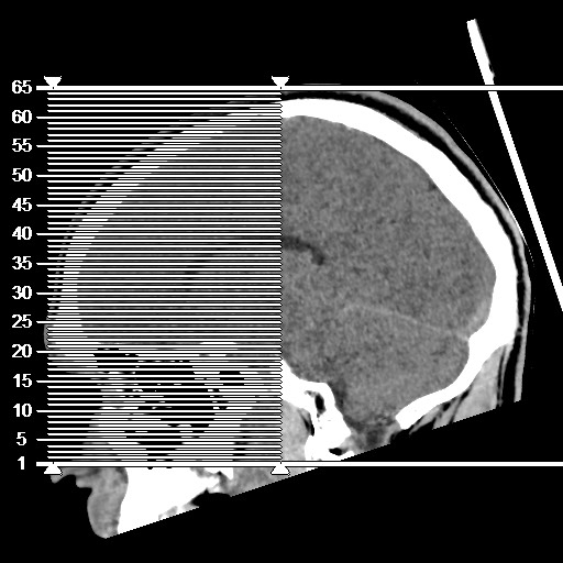 Brain death (Radiopaedia 78597-91360 Axial non-contrast 1).jpg