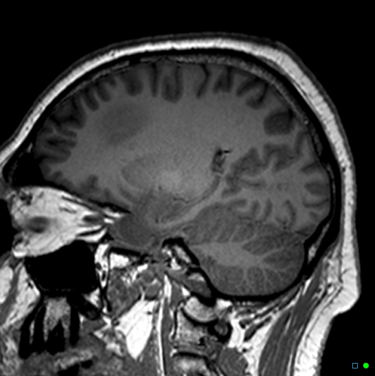 Brain death on MRI and CT angiography (Radiopaedia 42560-45689 Sagittal T1 3).jpg