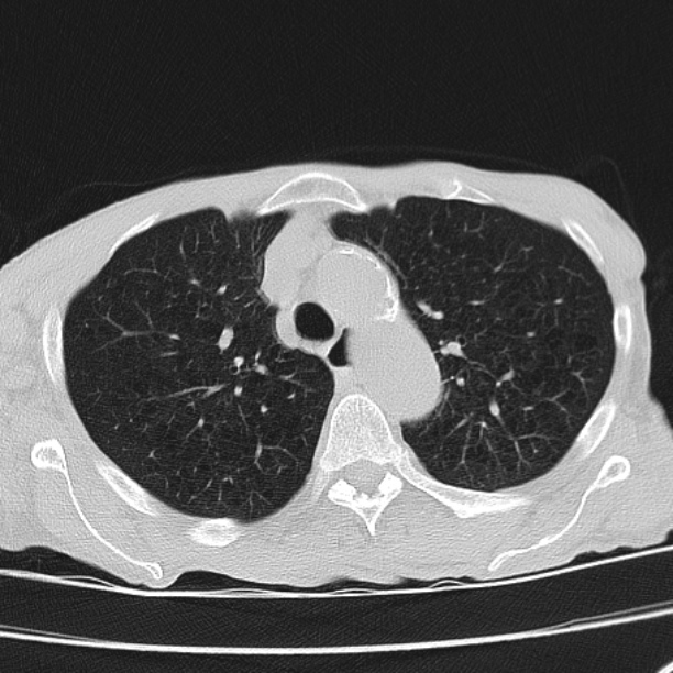 Brain metastases from lung cancer (Radiopaedia 27849-28093 Axial lung window 19).jpg