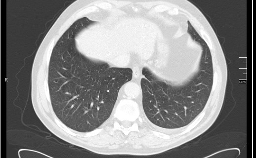 Brain metastases from squamocellular lung cancer (Radiopaedia 56515-63219 Axial lung window 51).jpg